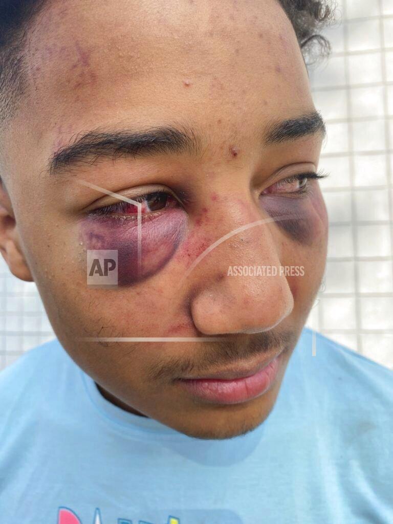 Uncredited This Dec 31 2020 photo provided by John L. Burris Law shows 17 year old Devin Carter with severe bruising after a beating by Stockton Police officers. A grand jury in California has indicted two police officers on felony assault charges in the alleged beating of an unresisting Black teenager last year. The San Joaquin County district attorney announced the indictments against the two former Stockton police officers Friday Sept. 17, 2021. (John L. Burris Law via AP)