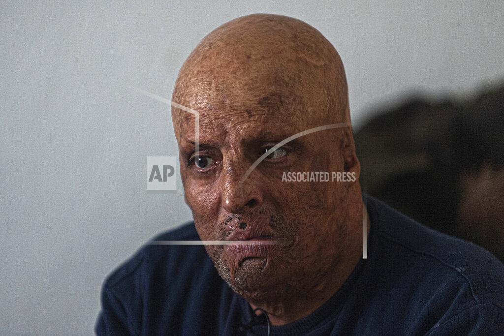 Riadh Dridi Hosni Kalaia, 49, talks in his house in Kasserine, Tunisia, Friday, Dec. 11, 2020. He's among hundreds of Tunisians who have turned to the desperate act of self-immolation as a form of protest in the past 10 years, following the example of Mohammed Bouazizi, a 26-year-old fruit seller who set himself ablaze on Dec. 17, 2010, to protest police harassment. (AP Photo/Riadh Dridi)