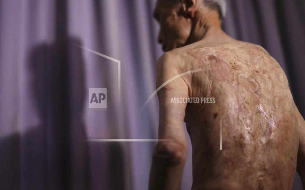 Eugene Hoshiko FILE - In this June 30, 2015, file photo, Sumiteru Taniguchi, a survivor of the 1945 atomic bombing of Nagasaki, shows his back with scars of burns from the atomic bomb explosion, during an interview at his office in Nagasaki, southern Japan. With dwindling survivors, Nagasaki marked 75th anniversary of US atomic bombing that killed more than 70,000 people on Sunday, Aug. 9, 2020. (AP Photo/Eugene Hoshiko, File)