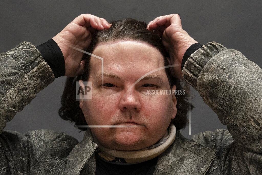 Mark Lennihan Joe DiMeo brushes back his hair while posing for a portrait, Monday, Jan. 25, 2021 at NYU Langone Health in New York, six months after an extremely rare double hand and face transplant. During a recent medical checkup, he practiced raising his eyebrows, opening and closing his eyes, puckering his mouth, giving a thumbs up and whistling. DiMeo can feel his new forehead, and often reaches up to push his long hair off of his face. (AP Photo/Mark Lennihan)