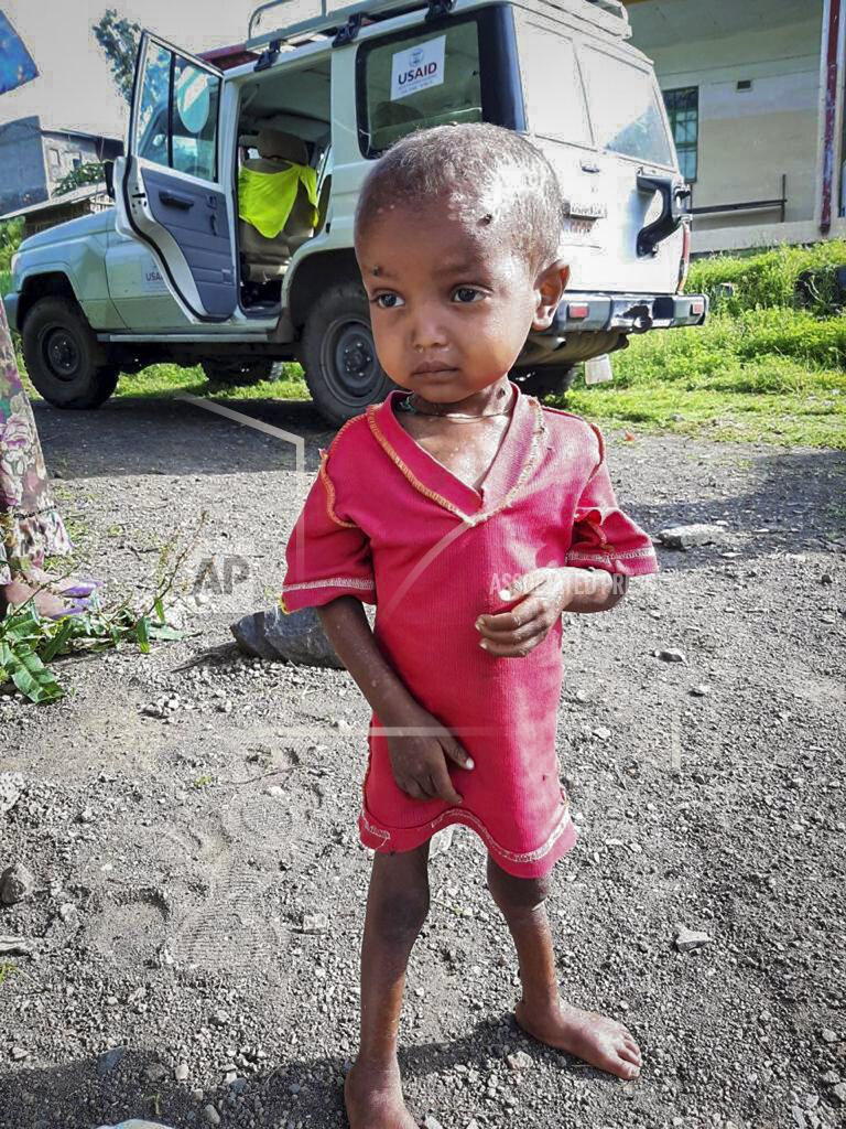 Uncredited In this photo provided anonymously, a severely malnourished child is seen at the Ayder Referral Hospital, where medicines have almost run out and hospital staffers haven't been paid since June, in Mekele, in the Tigray region of northern Ethiopia in September 2021. For months, the United Nations has warned of famine in Tigray and now internal documents and witness accounts reveal the first starvation deaths since Ethiopia's government in June imposed what the U.N. calls "a de facto humanitarian aid blockade." (UGC via AP)