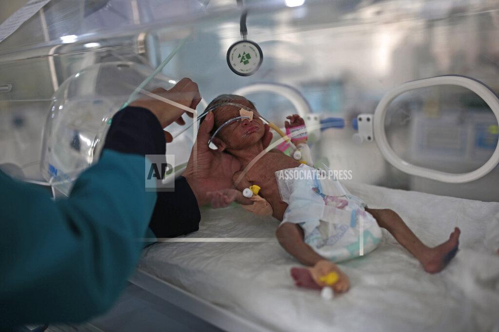 Hani Mohammed FILE - In this Saturday, June 27, 2020 file photo, a medic checks a malnourished newborn baby inside an incubator at Al-Sabeen hospital in Sanaa, Yemen. A UNICEF report predicted that the number of malnourished children could reach 2.4 million by the end of 2020, a 20% increase. (AP Photo/Hani Mohammed)