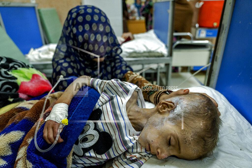 Ebrahim Noroozi An Afghan mother helps her acute malnourished boy at the Indira Gandhi hospital in Kabul, Afghanistan, Sunday, May 22, 2022. Some 1.1 million Afghan children under the age of five will face malnutrition by the end of the year. , as hospitals wards are already packed with sick children . (AP Photo/Ebrahim Noroozi)