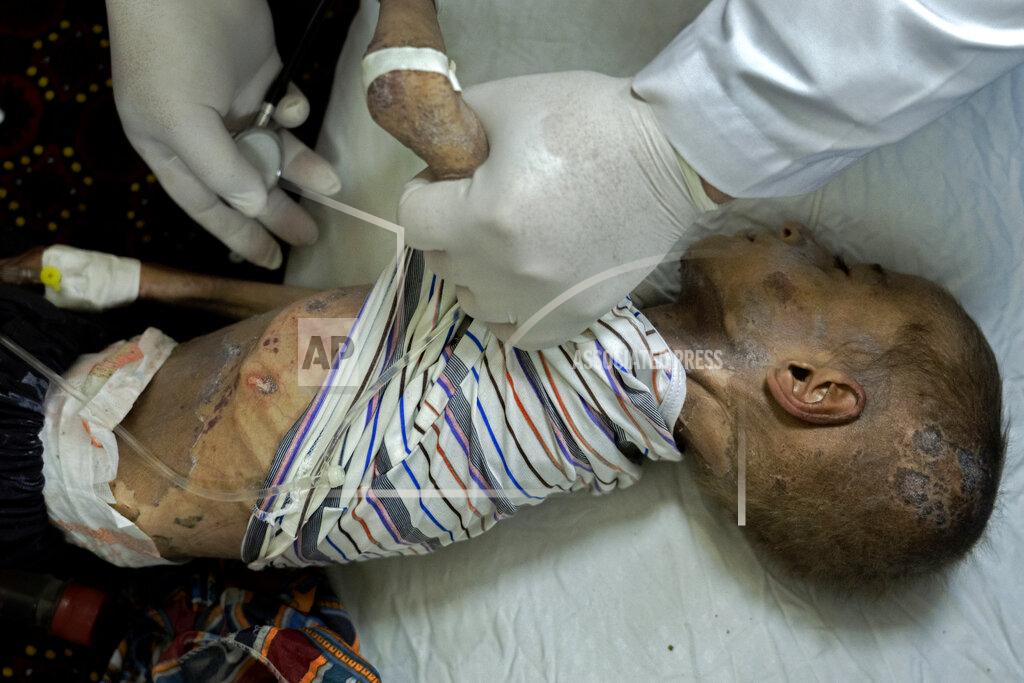 Ebrahim Noroozi An acute malnourished boy is treated at the Indira Gandhi hospital in Kabul, Afghanistan, Sunday, May 22, 2022. Some 1.1 million Afghan children under the age of five will face malnutrition by the end of the year. , as hospitals wards are already packed with sick children . (AP Photo/Ebrahim Noroozi)