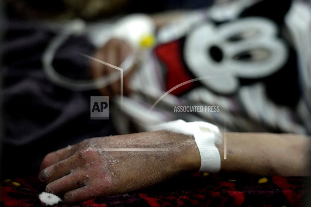 Ebrahim Noroozi An acute malnourished boy lies on a bed at the Gandhi hospital in Kabul, Afghanistan, Sunday, May 22, 2022. Some 1.1 million Afghan children under the age of five will face malnutrition by the end of the year. , as hospitals wards are already packed with sick children . (AP Photo/Ebrahim Noroozi)