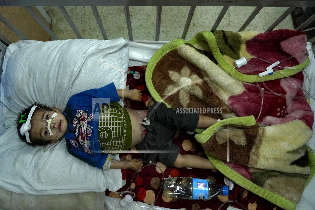 Ebrahim Noroozi An acute malnourished boy lies at the Indira Gandhi hospital in Kabul, Afghanistan, Wednesday, May 18, 2022. Some 1.1 million Afghan children under the age of five will face malnutrition by the end of the year. , as hospitals wards are already packed with sick children . (AP Photo/Ebrahim Noroozi)