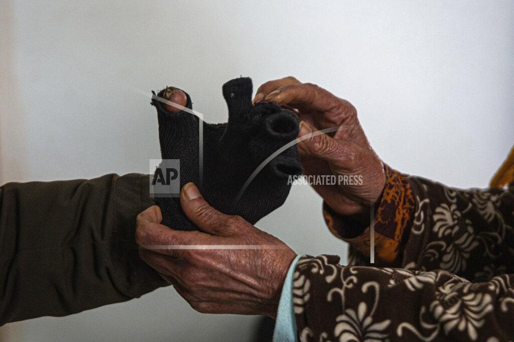 Riadh Dridi Zina Sehi, right, helps her son, Hosni Kalaia, to put on gloves in Kasserine, Tunisia, on Friday, Dec. 11, 2020. Kalaia is among hundreds of Tunisians who have turned to the desperate act of self-immolation in the past 10 years as a form of protest. Kalaia spent three years in a hospital and then a private clinic recovering from his burns. (AP Photo/Riadh Dridi)