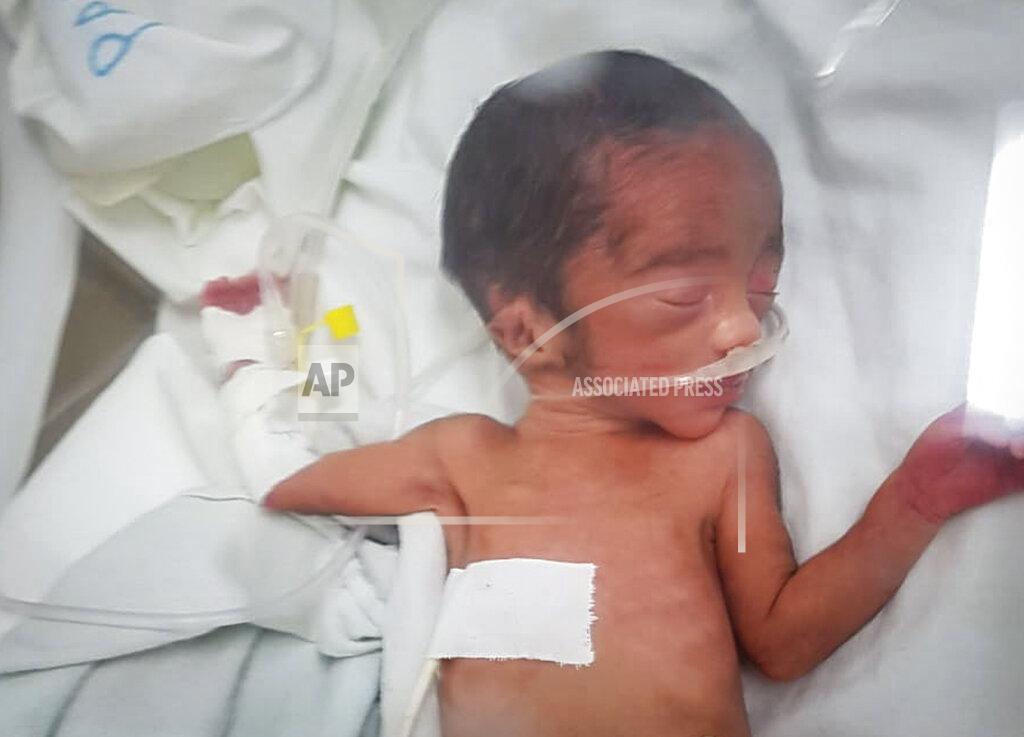 Uncredited In this photo provided anonymously, a newborn baby weighing just 800 grams (1.7 lbs) is treated in a clinic before dying shortly after he was born along with his malnourished mother on Tuesday, Sept. 14, 2021, in the Tigray region of northern Ethiopia. For months, the United Nations has warned of famine in Tigray and now internal documents and witness accounts reveal the first starvation deaths since Ethiopia's government in June imposed what the U.N. calls "a de facto humanitarian aid blockade." (UGC via AP)