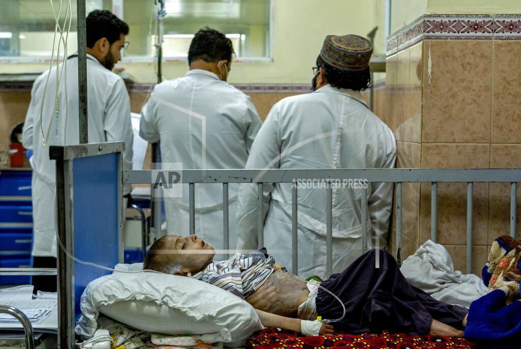 Ebrahim Noroozi An acute malnourished boy lies on a bed at the malnutrition ward of the Indira Gandhi hospital in Kabul, Afghanistan, Sunday, May 22, 2022. Some 1.1 million Afghan children under the age of five will face malnutrition by the end of the year. , as hospitals wards are already packed with sick children . (AP Photo/Ebrahim Noroozi)