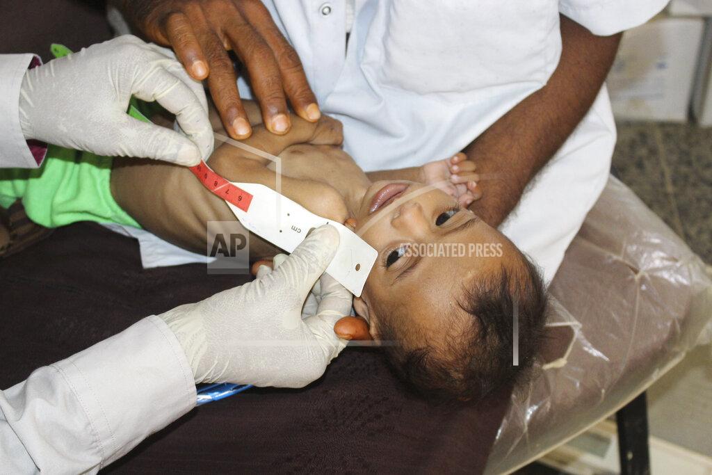 Issa Al-Rajhi In this Sunday, June 14, 2020 photo, seven-month-old Issa Ibrahim Nasser is measured at a clinic in Deir Al-Hassi, At seven months old, Issa weighs only three kilos. Like him, hundreds of children suffer from acute severe malnutrition because of poverty and grinding conflict. Yemen. (AP Photo/Issa Al-Rajhi)