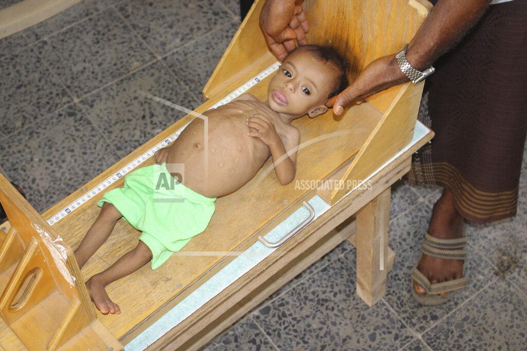 Issa Al-Rajhi In this Sunday, June 14, 2020 photo, seven-month-old Issa Ibrahim Nasser is measured at a clinic in Deir Al-Hassi, At seven months old, Issa weighs only three kilos. Like him, hundreds of children suffer from acute severe malnutrition because of poverty and grinding conflict. Yemen. (AP Photo/Issa Al-Rajhi)