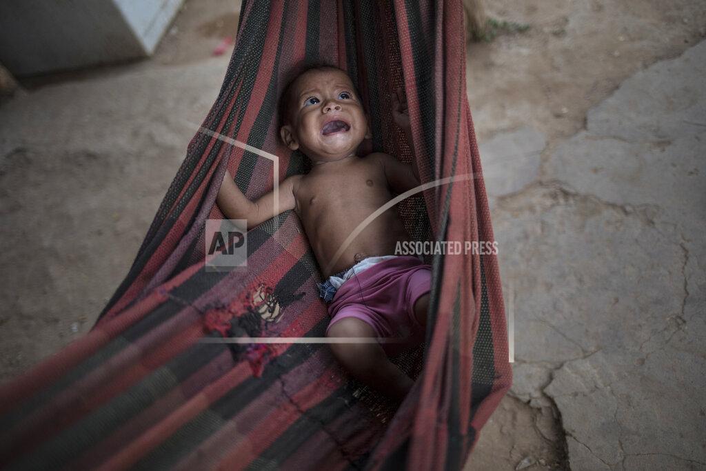 Rodrigo Abd FILE - In this Nov. 25, 2019 file photo, Osmery Vargas, who is malnourished, cries in a hammock as she and her 7-year-old sister Yasmery Vargas wait for their mother to return from begging in the street for money and food in Maracaibo, Venezuela. Even before the coronavirus pandemic in 2020, inflation had rendered many salaries nearly worthless and forced millions to flee abroad. (AP Photo/Rodrigo Abd)