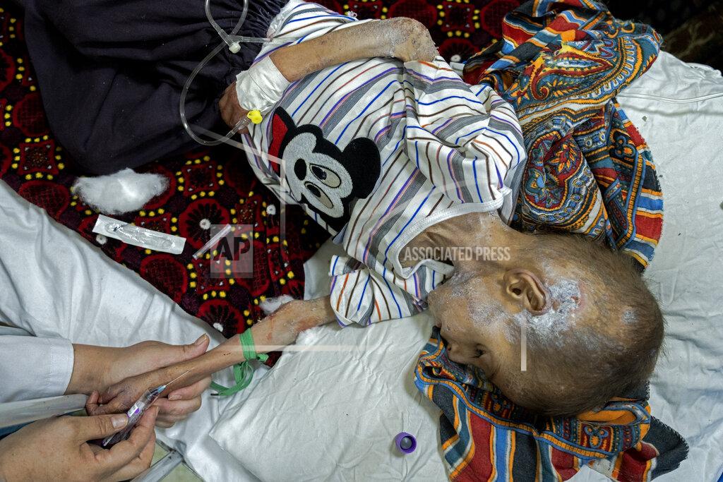Ebrahim Noroozi An acute malnourished boy is treated at the Indira Gandhi hospital in Kabul, Afghanistan, Sunday, May 22, 2022. Some 1.1 million Afghan children under the age of five will face malnutrition by the end of the year. , as hospitals wards are already packed with sick children . (AP Photo/Ebrahim Noroozi)