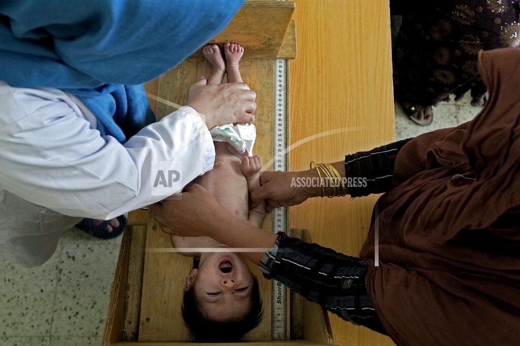 Ebrahim Noroozi A doctor measures a malnourished baby at f the Indira Gandhi hospital in Kabul, Afghanistan, Sunday, May 22, 2022. Some 1.1 million Afghan children under the age of five will face malnutrition by the end of the year. , as hospitals wards are already packed with sick children . (AP Photo/Ebrahim Noroozi)
