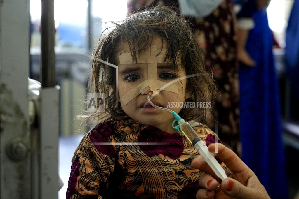Ebrahim Noroozi A malnourished girl treated at the Indira Gandhi hospital in Kabul, Afghanistan, Wednesday, May 18, 2022. Some 1.1 million Afghan children under the age of five will face malnutrition by the end of the year. , as hospitals wards are already packed with sick children . (AP Photo/Ebrahim Noroozi)