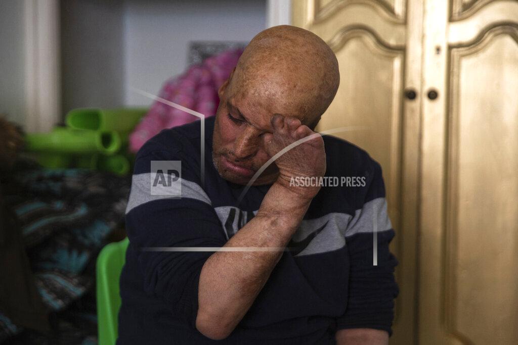 Riadh Dridi Hosni Kalaia, 49, reacts in his house in Kasserine, Tunisia, Friday, Dec. 11, 2020. He's among hundreds of Tunisians who have turned to the desperate act of self-immolation as a form of protest in the past 10 years, following the example of Mohammed Bouazizi, a 26-year-old fruit seller who set himself ablaze on Dec. 17, 2010, to protest police harassment. (AP Photo/Riadh Dridi)