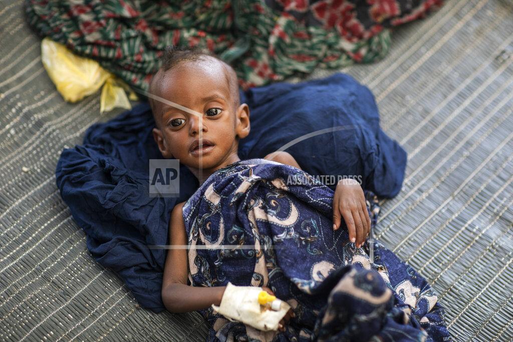 Zerihun Sewunet In this photo released by UNICEF, severely malnourished baby Mariyem lies in a temporary stabilisation center in the district of Afdera in the Afar region of Ethiopia Wednesday, May 11, 2022. According to UNICEF, the Afar region is facing multiple humanitarian emergencies and mass displacement due to drought and conflict, which has resulted in devastating food insecurity. (Zerihun Sewunet/UNICEF via AP)