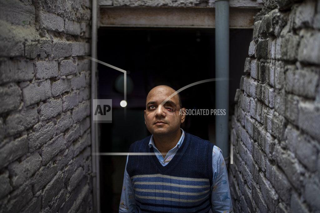 Altaf Qadri Muhammad Nasir Khan, who was shot by a Hindu mob during the February 2020 communal riots, poses for a photograph inside his home in North Ghonda, one of the worst riot affected neighborhood, in New Delhi, India, Friday, Feb. 19, 2021. As the first anniversary of bloody communal riots that convulsed the Indian capital approaches, Muslim victims are still shaken and struggling to make sense of their struggle to seek justice. (AP Photo/Altaf Qadri)