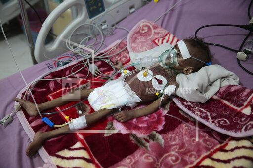 FILE - In this Nov. 3, 2020, file photo, malnourished girl, Rahmah Watheeq, receives treatment at a feeding center at Al-Sabeen hospital in Sanaa, Yemen. Countries like Lebanon, Syria, Iraq, Lebanon and Yemen are all teetering on the brink of humanitarian catastrophe with an economic implosion that threatens to throw the region into even deeper turmoil. (AP Photo/Hani Mohammed, File)