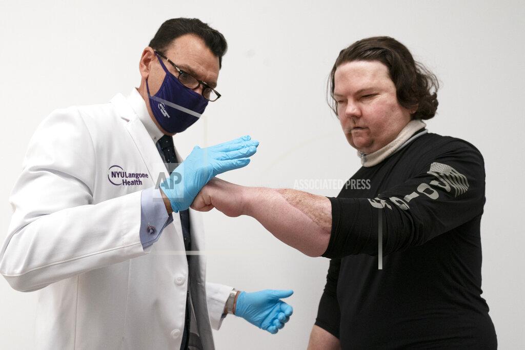 Mark Lennihan Dr. Eduardo Rodriguez has Joe DiMeo demonstrate the flexibility and strength in his hands, Monday, Jan. 25, 2021 at NYU Langone Health in New York, six months after an extremely rare double hand and face transplant. Rodriguez, who led the surgical team, said he’s amazed to see that DiMeo has been able to master skills like zipping up his jacket and putting on his shoes. “It’s very gratifying to all of us,” he said. “There’s a tremendous sense of pride.” (AP Photo/Mark Lennihan)