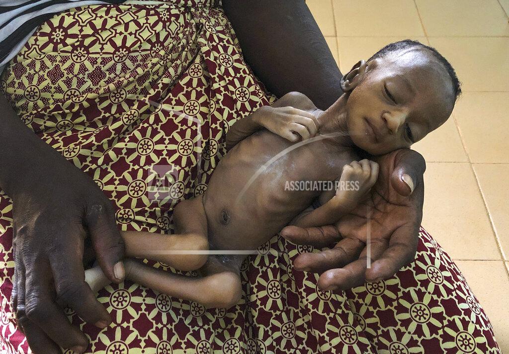 Sam Mednick One-month old Haboue Solange Boue, awaiting medical care for severe malnutrition, is held by her mother, Danssanin Lanizou, 30, at the feeding center of the main hospital in the town of Hounde, Tuy Province, in southwestern Burkina Faso on Thursday, June 11, 2020. With the markets closed because of coronavirus restrictions, her family sold fewer vegetables. Lanizou is too malnourished to nurse her. (AP Photo/Sam Mednick)