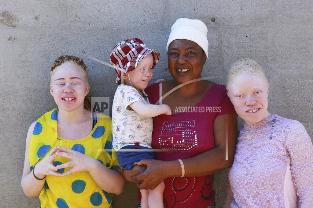 Joyce Muchenje,centre, poses for a photo with her three children, who all have albinism, outside their family home in Chitungwiza on the outskirts of Harare, in this Tuesday, June, 9, 2020. Muchenje used to provide for them by washing laundry and household cleaning for cross border traders at a busy border town before the lockdown, but now the border trade has stopped and Mutenje has run out of money to get the skin cream for her children. (AP Photo/Tsvangirayi Mukwazhi)