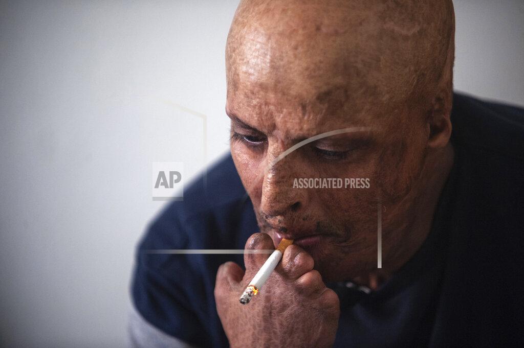 Riadh Dridi Hosni Kalaia, 49, smokes a cigarette in his house in Kasserine, Tunisia, Friday Dec.11, 2020. He's among hundreds of Tunisians who have turned to the desperate act of self-immolation in the past 10 years as a form of protest. Kalaia spent three years in a hospital and then a private clinic recovering from his burns. (AP Photo/Riadh Dridi)