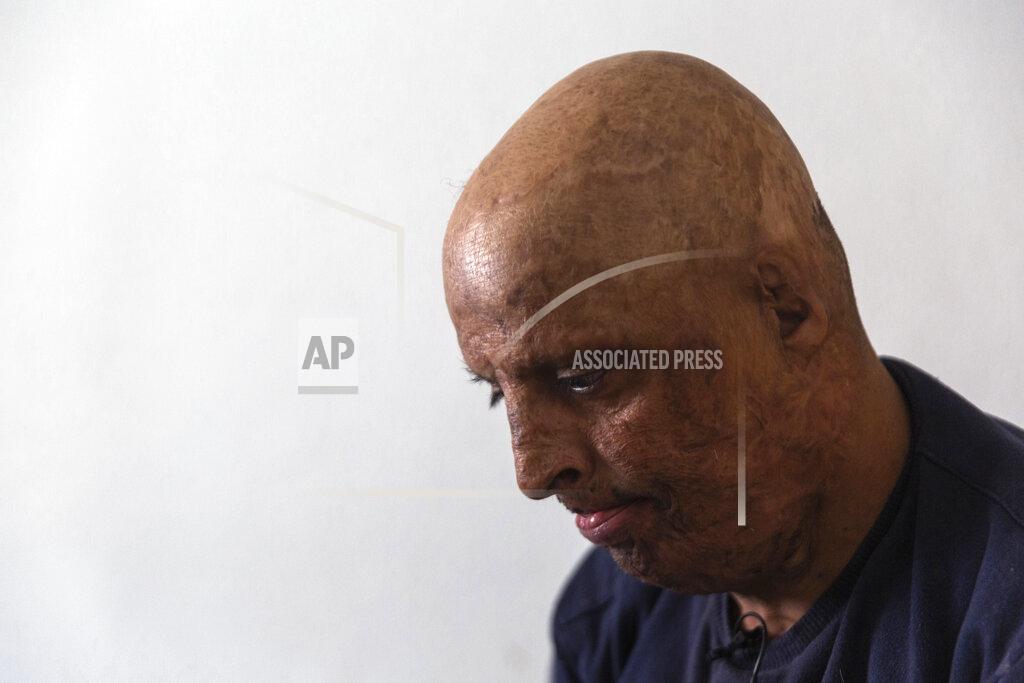 Riadh Dridi Hosni Kalaia, 49, looks down in his house in Kasserine, Tunisia, Friday, Dec. 11, 2020. He's among those Tunisians who followed the example of Mohammed Bouazizi, a 26-year-old fruit seller who set himself ablaze on Dec. 17, 2010, to protest police harassment. Kalaia spent three years in a hospital and then a private clinic recovering from his burns. (AP Photo/Riadh Dridi)