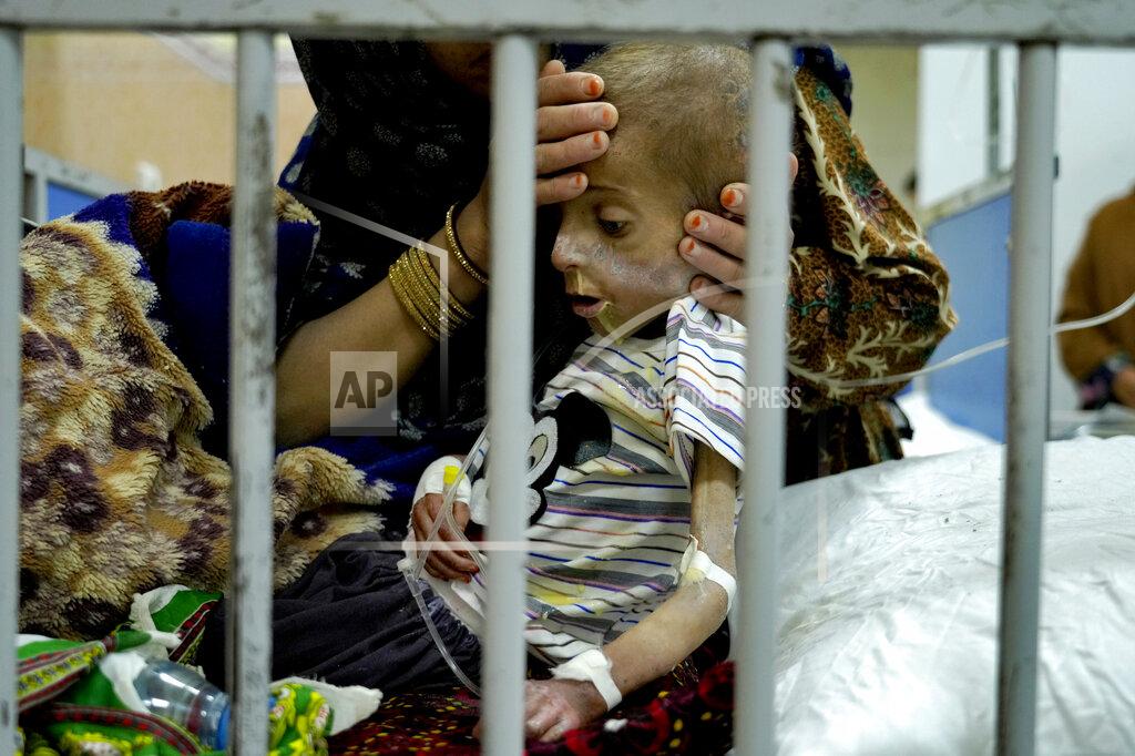 Ebrahim Noroozi An Afghan mother helps her malnourished boy in he Indira Gandhi hospital in Kabul, Afghanistan, Sunday, May 22, 2022. Some 1.1 million Afghan children under the age of five will face malnutrition by the end of the year. , as hospitals wards are already packed with sick children . (AP Photo/Ebrahim Noroozi)