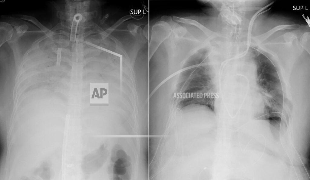 This combination of radiographs provided on April 9, 2021, by Kyoto University Hospital, shows the chest of a patient before the surgery, left, and after the surgery, right. Doctors in Kyoto University Hospital announced Thursday, April 8, 2021, they have successfully performed the world’s first transplant of lung tissue from living donors to a patient with severe lung damage from COVID-19. (Kyoto University Hospital via AP)