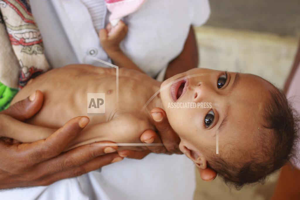 Issa Al-Rajhi In this Sunday, June 14, 2020 photo, seven-month-old Issa Ibrahim Nasser is brought to a clinic in Deir Al-Hassi, At seven months old, Issa weighs only three kilos. Like him, hundreds of children suffer from acute severe malnutrition because of poverty and grinding conflict. Yemen. (AP Photo/Issa Al-Rajhi)