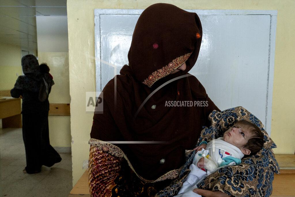 Ebrahim Noroozi A mother holds her malnourished baby at the malnutrition ward of the Indira Gandhi hospital in Kabul, Afghanistan, Wednesday, May 18, 2022. Some 1.1 million Afghan children under the age of five will face malnutrition by the end of the year. , as hospitals wards are already packed with sick children . (AP Photo/Ebrahim Noroozi)
