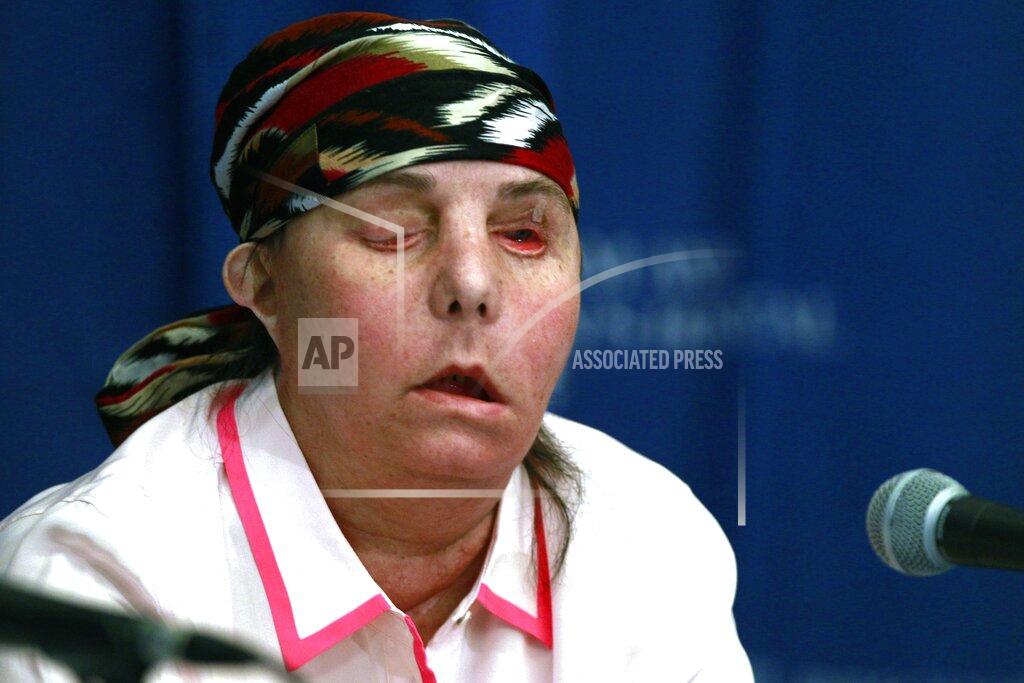 FILE - In this May 1, 2013, file photo, Carmen Blandin Tarleton speaks at Brigham and Women's Hospital in Boston following a face transplant. In February 2007 her estranged husband doused her with industrial strength lye, burning more than 80 percent of her body. In July 2020, Tarleton became the first American and only the second person globally to undergo a second face transplant procedure after her first transplant failed. (AP Photo/Charles Krupa, File)