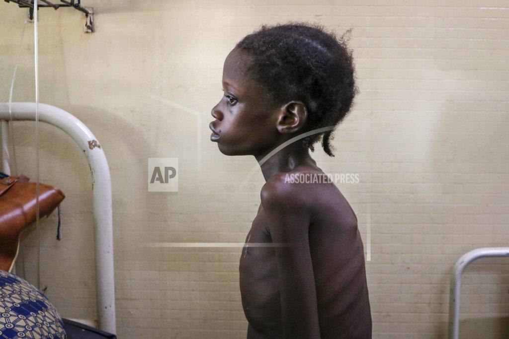 Sam Mednick Nafissetou Niampa, 14, who struggles to breathe due to a heart condition, is treated for malnutrition at Yalgado Ouedraogo University in Ouagadougou, Burkina Faso on Monday, June 22, 2020. Coronavirus-related movement restrictions limited her family's ability to make money to pay for medicine and buy food. (AP Photo/Sam Mednick)