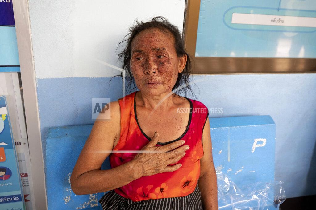 Sakchai Lalit FILE - In this Tuesday March 30, 2021, file photo, an injured Karen villager from Myanmar rests at Ban Mae Sam Laep Health Center in Mae Hong Son province, northern Thailand, after they crossed Salawin river on a boat. Far away in Myanmar’s borderlands, millions of others who hail from Myanmar’s minority ethnic groups are facing increasing uncertainty and waning security as longstanding conflicts between the military and minority guerrilla armies flare anew. (AP Photo/Sakchai Lalit, File)