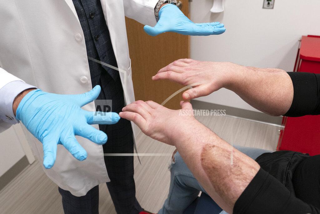 Mark Lennihan Joe DiMeo, right, demonstrates the flexibility in his fingers for Dr. Eduardo Rodriguez, Monday, Jan. 25, 2021 at NYU Langone Health in New York. A surgical team, led by Rodriguez, amputated both of DiMeo’s hands, replacing them mid-forearm and connecting nerves, blood vessels and 21 tendons with hair-thin sutures. The scar on DiMeo's forearm shows where the new hand was attached. (AP Photo/Mark Lennihan)