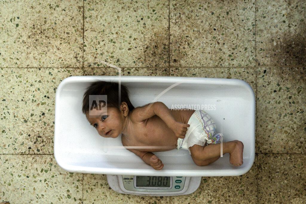 Ebrahim Noroozi A malnourished baby is weighed at the Indira Gandhi hospital in Kabul, Afghanistan, Sunday, May 22, 2022. Some 1.1 million Afghan children under the age of five will face malnutrition by the end of the year. , as hospitals wards are already packed with sick children . (AP Photo/Ebrahim Noroozi)