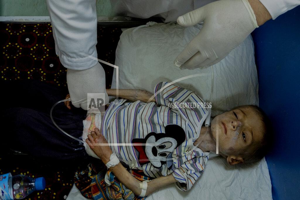 Ebrahim Noroozi A doctor examines an acute malnourished boy at the Indira Gandhi hospital in Kabul, Afghanistan, Sunday, May 22, 2022. Some 1.1 million Afghan children under the age of five will face malnutrition by the end of the year. , as hospitals wards are already packed with sick children . (AP Photo/Ebrahim Noroozi)