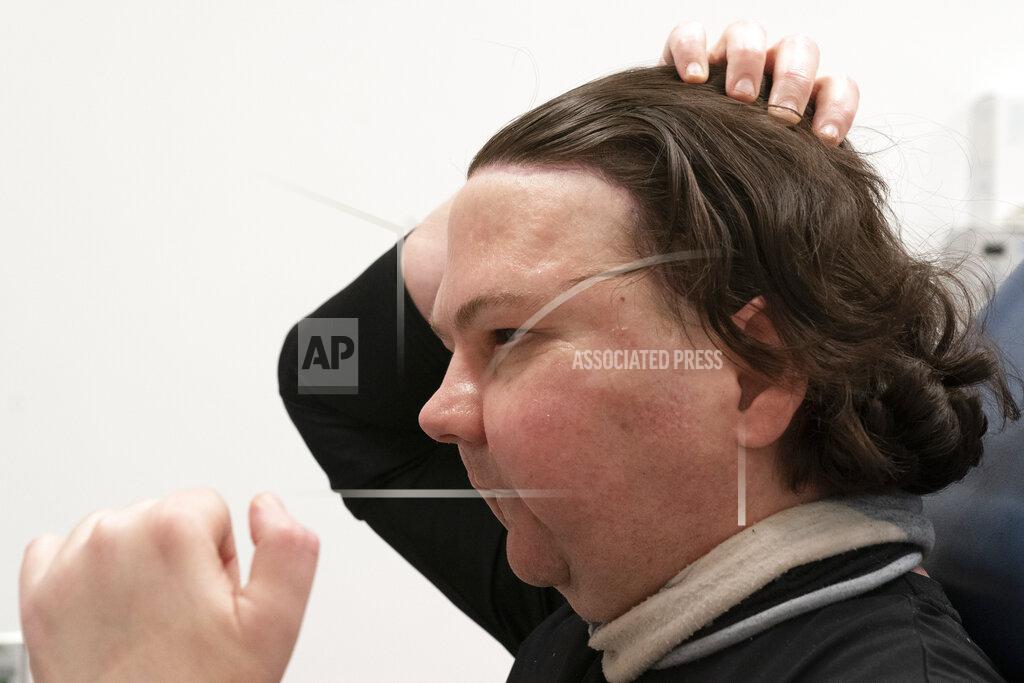 Mark Lennihan Joe DiMeo demonstrates how he can arrange his hair, Monday, Jan. 25, 2021 at NYU Langone Health in New York, six months after an extremely rare double hand and face transplant. In the 23-hour procedure the medical team replaced his full face, including the forehead, eyebrows, nose, eyelids, lips, both ears and underlying facial bones. (AP Photo/Mark Lennihan)
