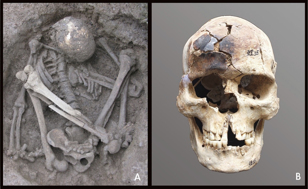 This undated combination photo provided by Hirofumi Matsumura shows a crouched mummy in Guangxi, China, with burn marks on its skull. (Li Zhen and Hirofumi Matsumuravia via AP)