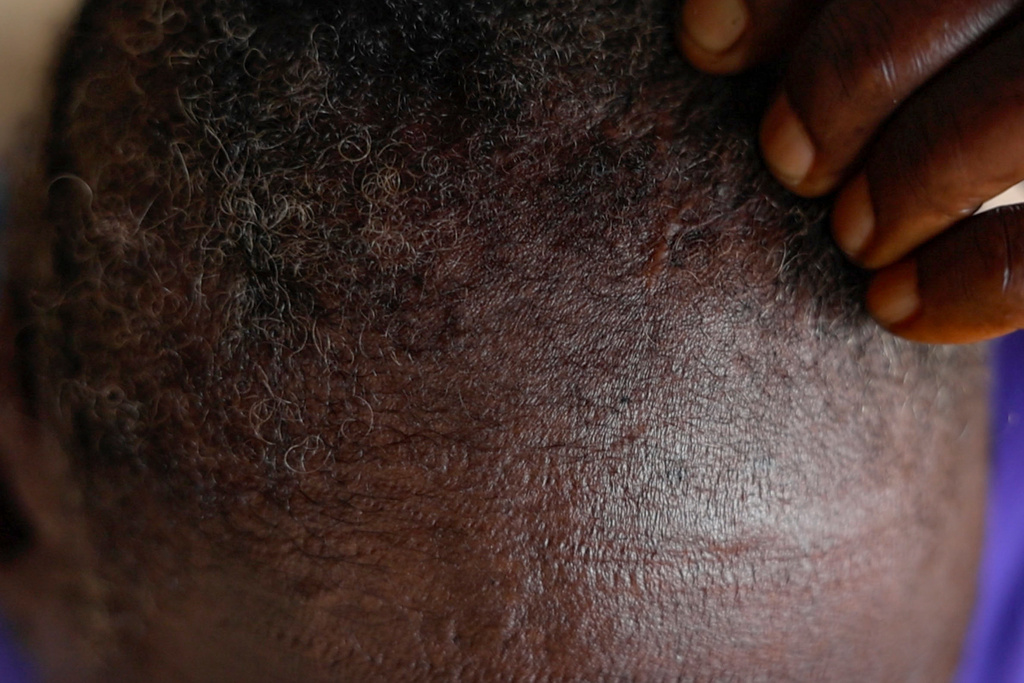 Satta Surtual shows a scar from an injury sustained during a protest in Gogioma, Liberia, July 9, 2025. (AP Photo/Misper Apawu)