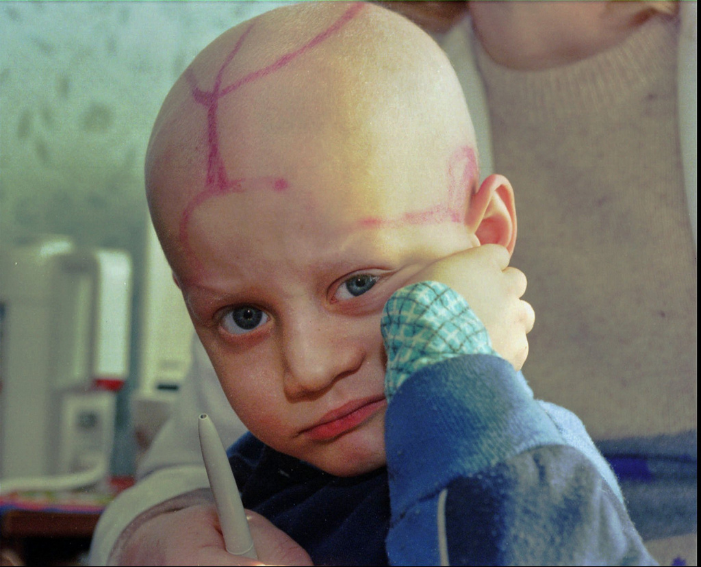 FILE - Alec Zhloba sits in a children's cancer ward with markings made by doctors on his head following chemotherapy in Gomel, Belarus, March 19, 1996, nearly 10 years after the explosion and fire at the Chernobyl nuclear power plant sent radioactive clouds through Ukraine, Belarus and other parts of Europe. (AP Photo/Efrem Lukatsky, File)