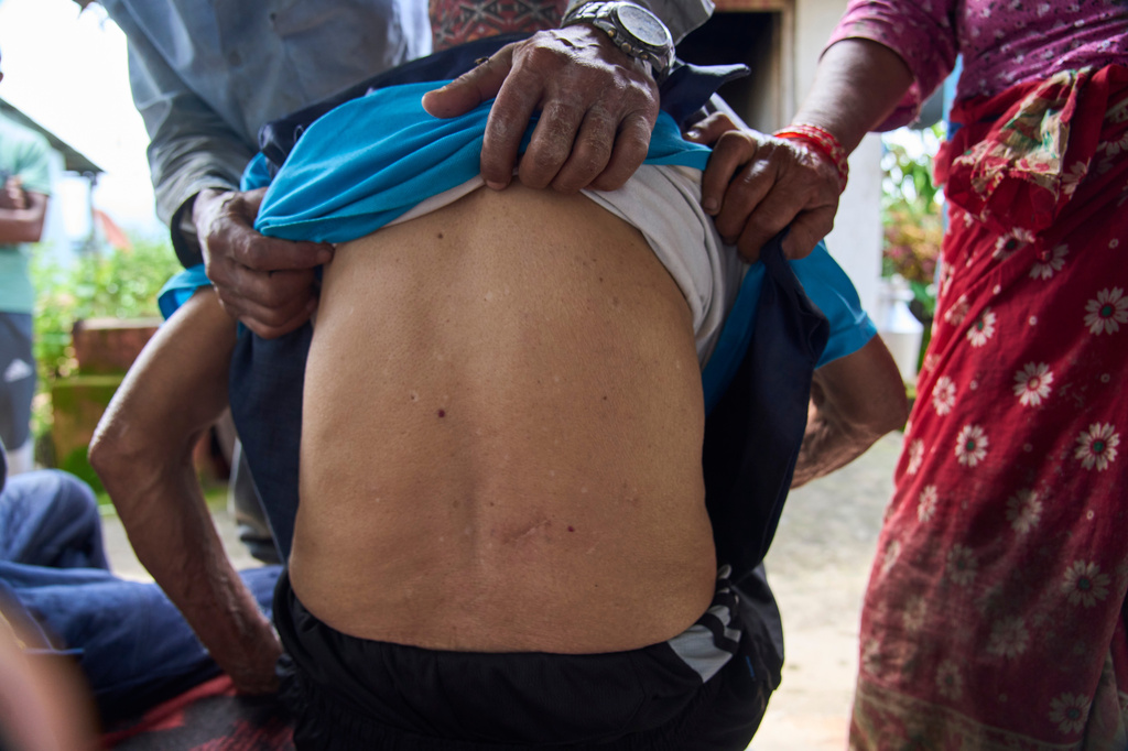 Krishna Bahadur Khadka, 73, shows scars from monkey bites after he was attacked while guarding his crop in Dharamghar, Dolakha district, about 86 kilometers (53 miles) east of Kathmandu, Nepal, Friday, July 24, 2026. (AP Photo/Niranjan Shrestha)