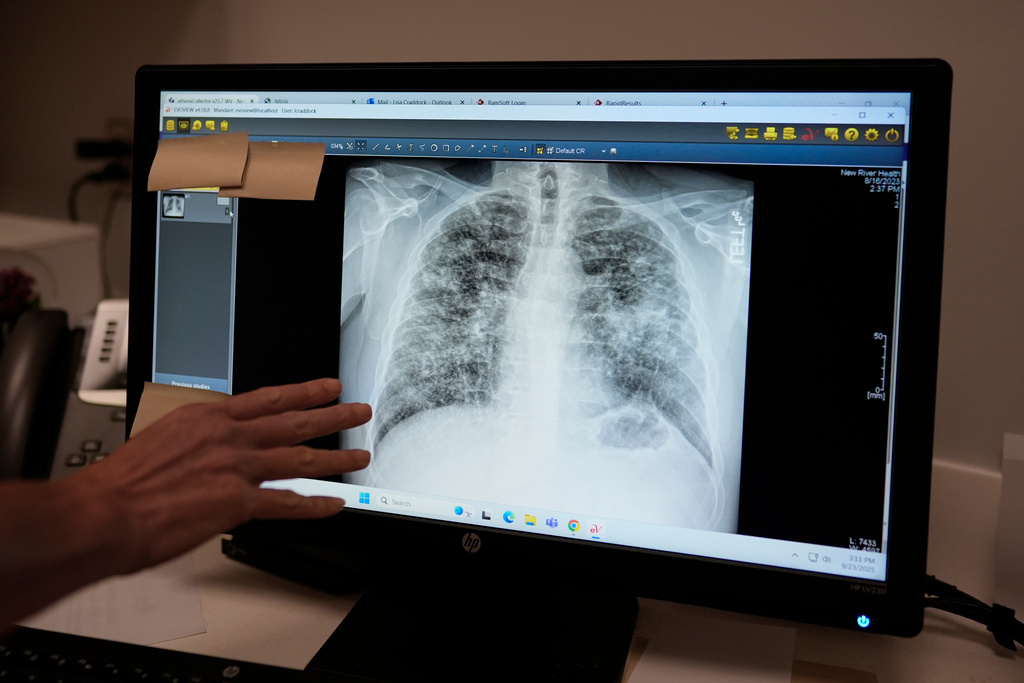Lisa Emery, director of the New River Health Association Black Lung Clinic, examines a chest X-ray showing progressive massive fibrosis, the most complicated form of black lung, at the center on Sept. 23, 2025, in Oak Hill, W.Va. (AP Photo/Carolyn Kaster)