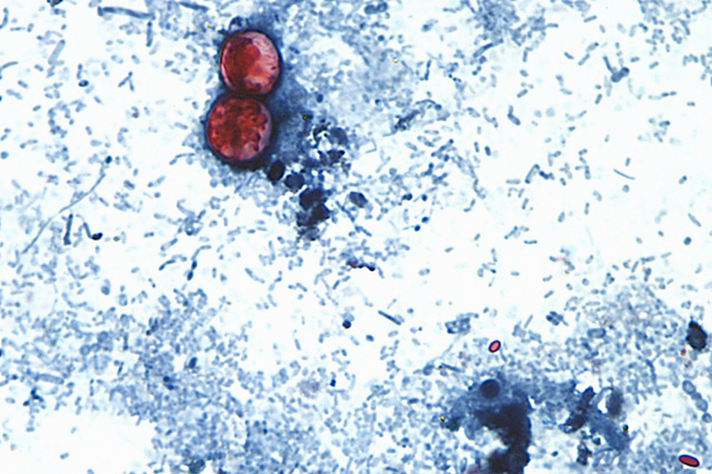 FILE - This undated photo taken through a microscope and provided by the CDC shows Cyclospora cayetanensis oocysts found in a fresh stool sample which had been prepared with a formalin solution and stained with safranin. (CDC via AP, File)
