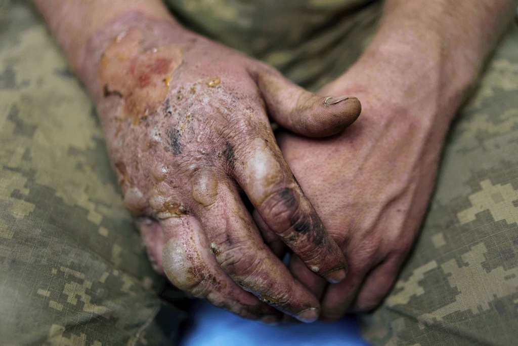 Burns are seen on the hands of a Ukrainian soldier of Da Vinci Wolves Battalion who was injured during fighting with Russian forces at the front line on Pokrovsk direction, Ukraine, on Sunday, Aug. 10, 2025. (AP Photo/Evgeniy Maloletka)