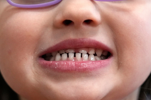 FILE - A child shows off her teeth after a dental exam in Concord, N.H., Wednesday, Feb. 21, 2024. (AP Photo/Robert F. Bukaty, file) FILE - A child shows off her teeth after a dental exam in Concord, N.H., Wednesday, Feb. 21, 2024. (AP Photo/Robert F. Bukaty, file)
