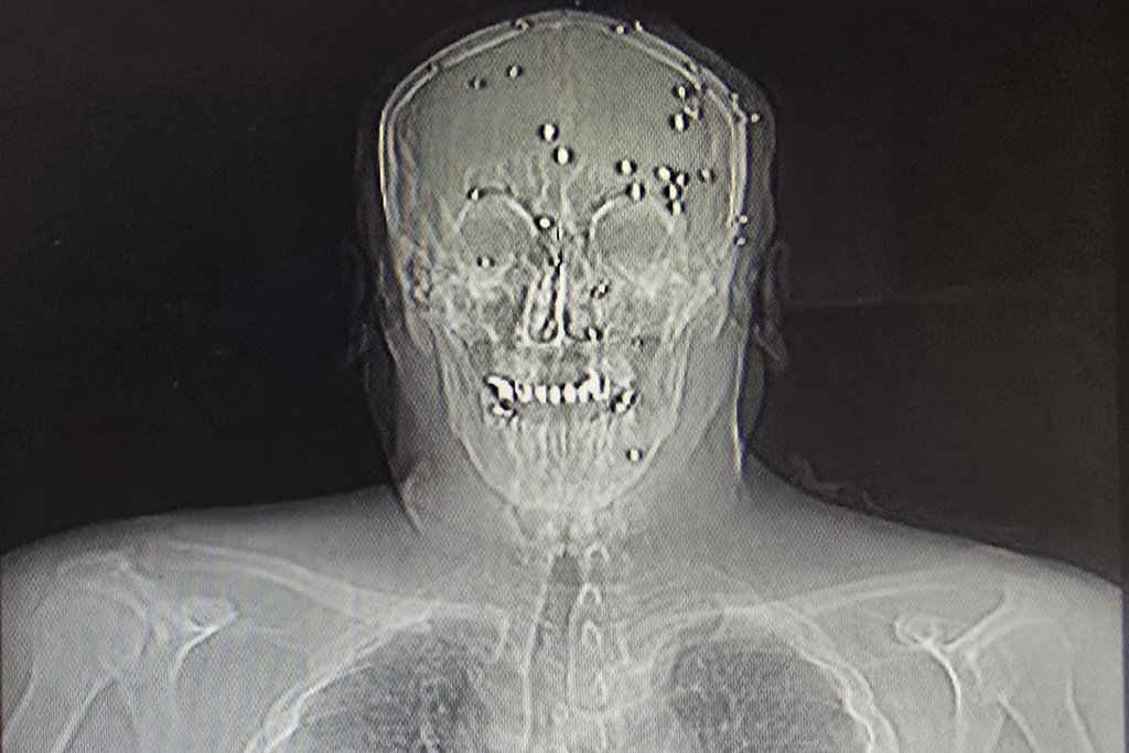 This is a photo of an X-ray image taken Jan. 9, 2026, obtained outside Iran, showing an Iranian protester who was hit in the face by pellets in Rasht, northern Iran. (UGC via AP)