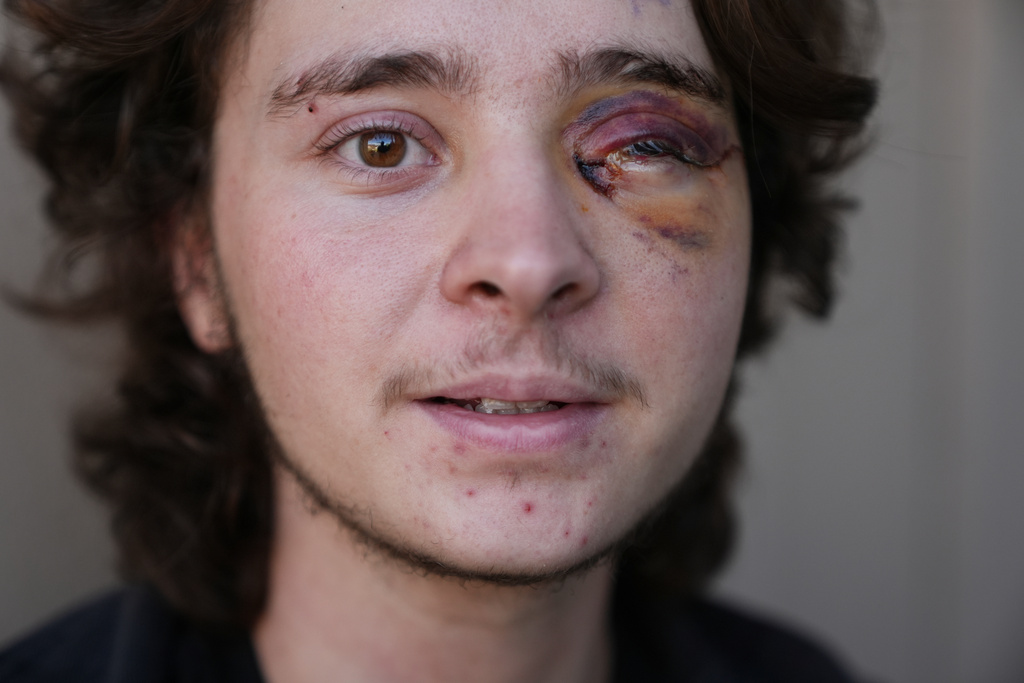 Kaden Rummler, who was injured after being hit with a projectile fired by a federal agent during a protest outside an immigration building in Santa Ana, Calif., poses for a portrait Wednesday, Jan. 14, 2026, in Southern California. (AP Photo/Damian Dovarganes)