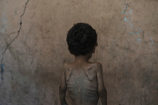 FILE.- Yazan Abu Ful, a 2-year-old malnourished child, poses for a photo at his family home in the Shati refugee camp, in Gaza City on Wednesday, July 23, 2025. (AP Photo/Jehad Alshrafi,File) FILE.- Yazan Abu Ful, a 2-year-old malnourished child, poses for a photo at his family home in the Shati refugee camp, in Gaza City on Wednesday, July 23, 2025. (AP Photo/Jehad Alshrafi,File)